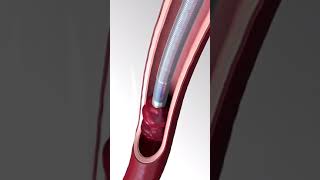 How Blood Clots Are Removed  3d animation bloodclotting stroke vascularsurgery thrombectomy [upl. by Pahl]