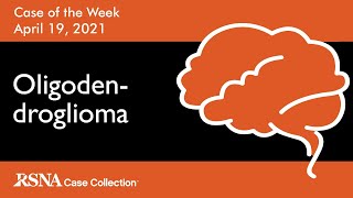 Case of the Week Oligodendroglioma [upl. by Delphina]