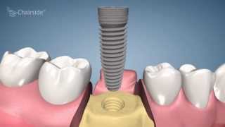 Dental Implant Procedure  One Stage [upl. by Ross]