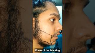 Beard Transplant Results 2022  Hair Transplant Results 2022 beardtransplant hairtransplantindia [upl. by Eenaj]