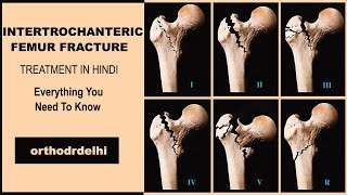 INTERTROCHANTRIC FRACTURE FEMUR IN HINDI proximal femur fractures IN HINDI [upl. by Gant]