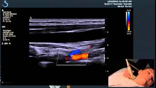 Hot Tips  Finding the Vertebral Artery with Ultrasound [upl. by Dovev]