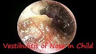 Vestibulitis Common In Child due to Rhinitis Sinusitis  Nasal Allergy amp Adenoid Hypertrophy [upl. by Netfa]