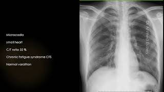 CASE 848 microcardia small heart [upl. by Madid]