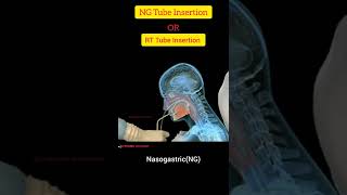 NG  Nasogastric  Tube Insertion Techniquen In Hindi ll RT Tube Insertion Procedure ll SG Pharma [upl. by Arikihs210]