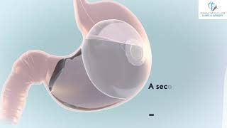 Elipse Intragastric Balloon Animation Video [upl. by Acnaib]