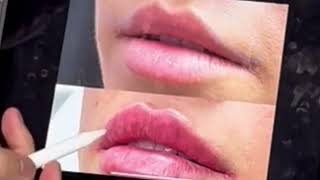 NO DISSOLVE LIP FILLER ANALYSIS [upl. by Nallek]