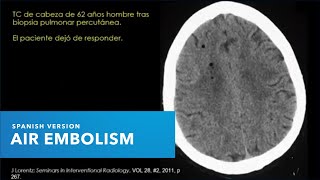 Prevención y detección de la embolia gaseosa con el Dr Steve Barker MD PhD versión en español [upl. by Meelas]