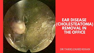 EAR diseaseCholesteatoma removal in the office [upl. by Skip]