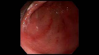 Gastroduodenitis withoesophageal candidiasis [upl. by Aley568]