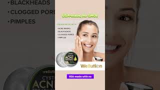 Wellution Cystic Acne Treatment face Cream howtolightendarkspots antiaging [upl. by Anama]