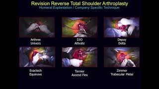 Sugical Techniques  Failed Reverse Total Shoulder Arthroplasty [upl. by Sullecram]