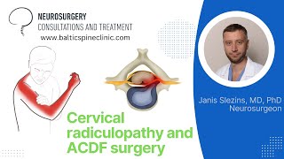 Cervical disc herniation [upl. by Abba]