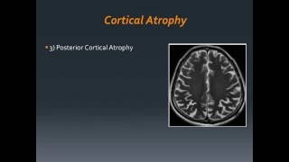 Listen to Authors MR imaging in Alzheimers Disease [upl. by Ardekahs]