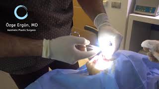 Upper Lip Lift Surgery  Ozge Ergun MD  Plastic Surgery  Istanbul [upl. by Atsuj]