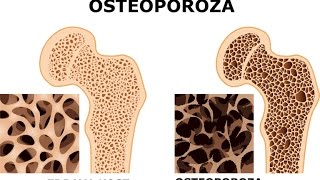 Prirodni lek koji pomaze kod osteoporoze [upl. by Innavoij]