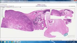 Mucoepidermoid Carcinoma Salivary gland tumor 🔬salivarygland cancer tumors [upl. by Acirne700]