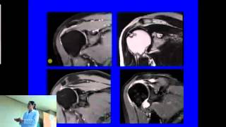 Resonancia Magnética Nuclear en Hombro [upl. by Ric]