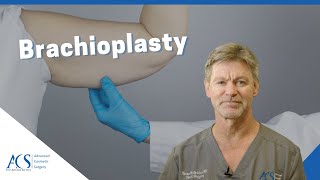 Brachioplasty Surgery Explained By Plastic Surgeon What is it Scars Recovery and More [upl. by Dyane130]