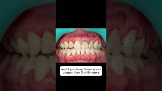 PERIODONTAL DISEASE HIDDEN THREATS amp CAUSES 🦷🦠🌿✨ [upl. by Aihsyn240]