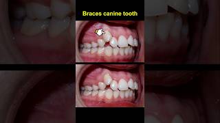 Braces crooked teeth evolution braces orthodontist bracket dentist [upl. by Camroc]