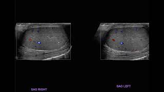 ultrasound epididymoorchitis [upl. by Devine194]