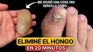 Los hongos de las uñas se pueden eliminar en 20 minutos en casa con un simple [upl. by Finegan]