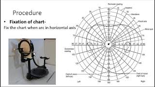 perimetry viva questions [upl. by Garbe]