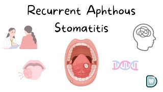 Understanding Recurrent Aphthous Stomatitis RAS or Oral Aphthous Ulcers [upl. by Hayne316]