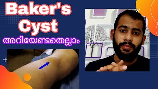 Bakers Cyst MalayalamSymptoms causesTreatment [upl. by Ecirpac22]