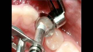 Amalgam Fillings Procedure  Lake Merritt Dental Oakland CA [upl. by Iva]