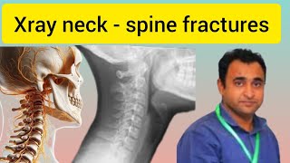 cervical spine fractures radiology  part 2 [upl. by Negrom]