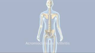 Acromioclavicular Arthritis [upl. by Beyer108]