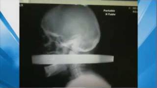 XRay Man Impaled by Pipe in Head Survives [upl. by Rudman]