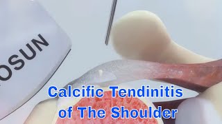 Get Relief From Calcific Tendinitis Of The Shoulder With Surgery And Injection Treatment [upl. by Rimaj332]