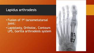 A comparison of current types of bunion surgery [upl. by Neladgam]