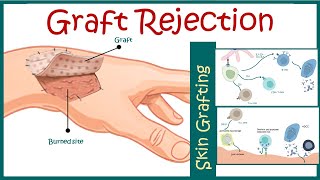 Graft rejection  Immunological basis of graft rejection [upl. by Coveney]