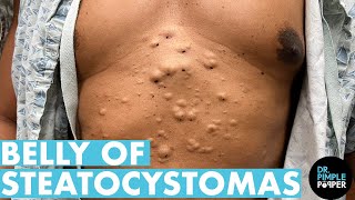 A Belly Full Of Steatocystomas Dr Pimple Popper Mines a Patients Stomach  Part 1 [upl. by Araj]