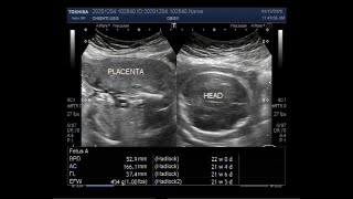 Ultrasound Video showing Oligohydromnios loss of fetal movements with Pregnancy of about 22 weeks [upl. by Zantos]