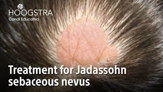 Treatment for Jadassohn sebaceous nevus  22199 [upl. by Lipinski617]