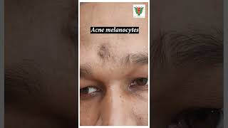 Melanocytes Acne Removal by laser  DrSanjeeb Rout [upl. by Ylen190]