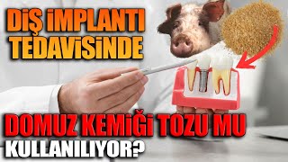 Diş implantı tedavisinde domuz kemiği tozu mu kullanılıyor [upl. by Joelynn]