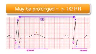 ECG basics 1010  The QT Interval [upl. by Learsiy396]