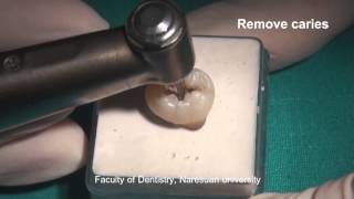 Removal of the carious lesion [upl. by Adnilg]