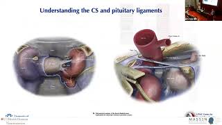 Revisiting Operability Within the Cavernous Sinus  MASSIN Congress Day 3  Session 12 Talk 2 [upl. by Aidam743]