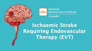 Understanding Stroke Treating Stroke with Endovascular Therapy EVT [upl. by Alinoel]