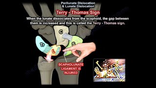 Perilunate amp Lunate Dislocation  Everything You Need To Know  Dr Nabil Ebraheim [upl. by Coreen415]