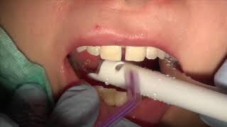 How to close gap between front teeth Cosmetic Dentistry Los Angeles CA Tel 8187760055 [upl. by Pieter]