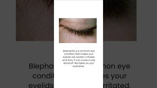 Blepharitis is inflammation of lidsblepharitis dandruff eyelasheswhat is blepharitis [upl. by Karena]