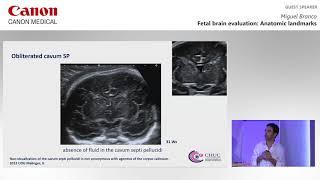 ISUOG 2019  Miguel Branco on utilizing ultrasound imaging techniques during fetal brain evaluation [upl. by Annaid]